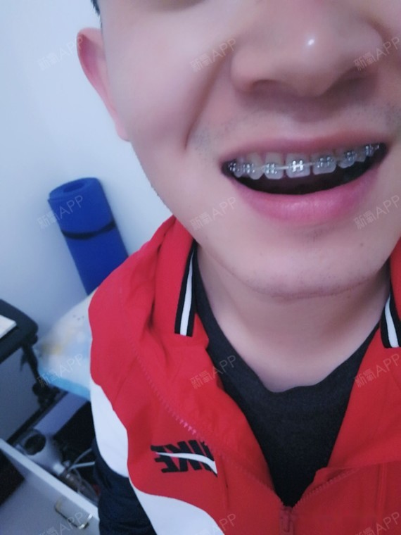 男生正畸还是比较少的 工作后带的牙套