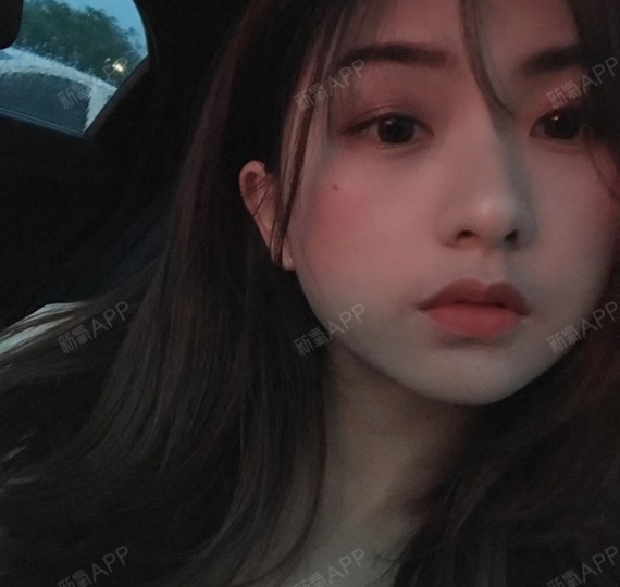 丰太阳**打玻尿酸能维持多久_下巴填充玻尿酸能维持多久_玻尿酸太阳**填充能维持多久