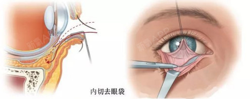 33-45岁的中年人:眼部皮肤松弛,但无眶隔松弛,故无眶隔脂肪突出,眼