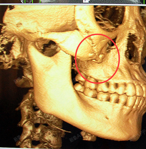 颧骨钛钉,到底要不要取,不取的话能不能做超声提升/热玛吉/核磁共振?