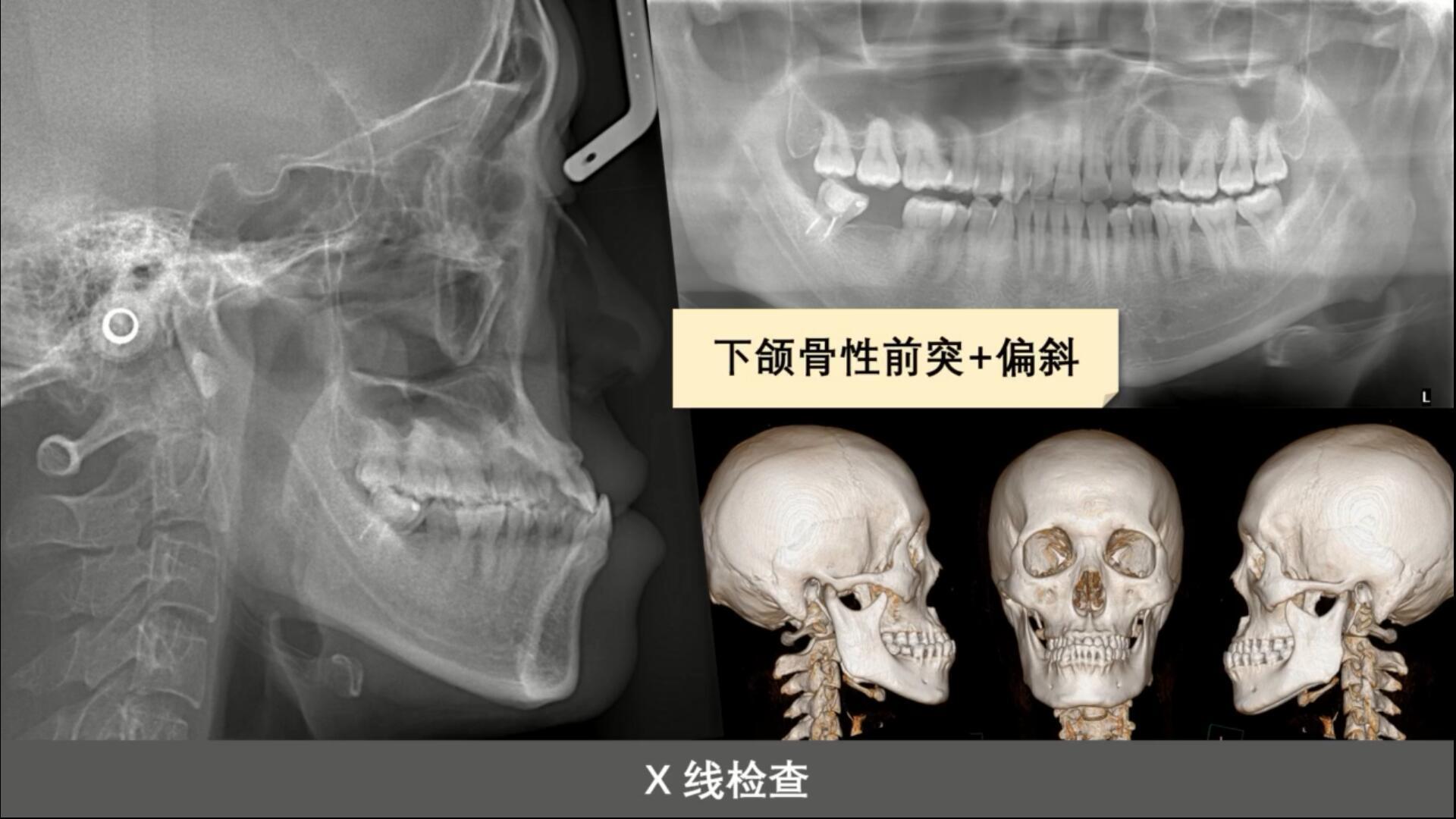 想要知道自己是牙性还是骨性嘴凸要去拍的叫什么啊?