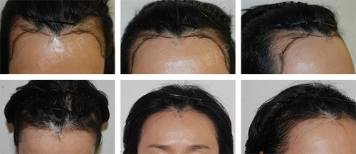 韩国常见的几种额头缩小手术方式对比,来看看自己适合哪种术式!