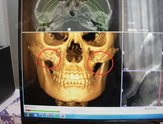 颧骨钛钉,到底要不要取,不取的话能不能做超声提升/热玛吉/核磁共振?