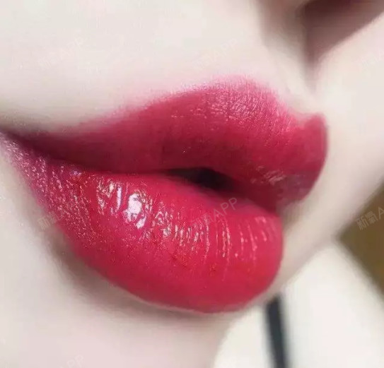 m唇术后会留疤吗?要注意哪些事情?