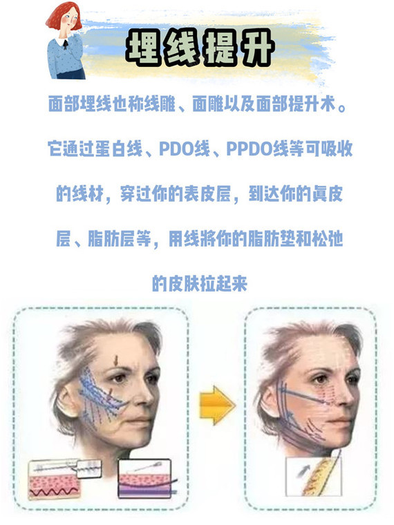 但作用层次较深,提拉轮廓的效果非常优越97埋线提升侧重抗衰美肤