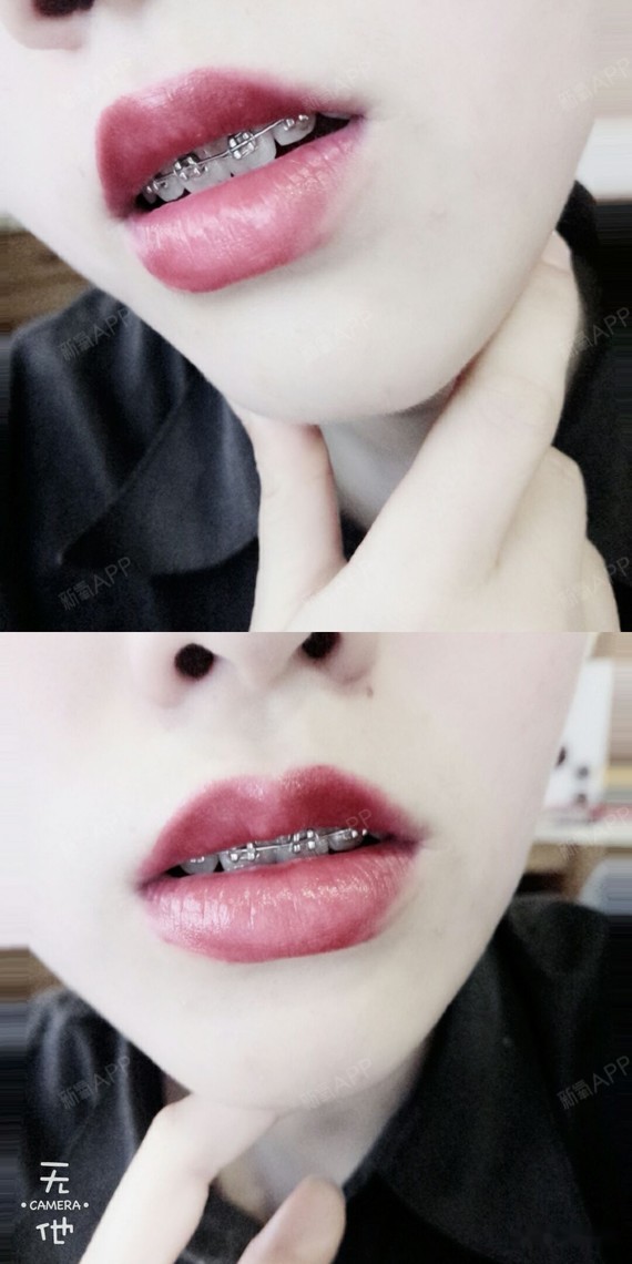 外形大概就这样吧,带牙套的时候嘴巴是真的会往外翻的,就像杨颖之前