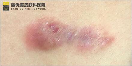 有救了 疤痕体质增生治疗 激光软化组织美白色素沉淀 圈子 新氧美容整形