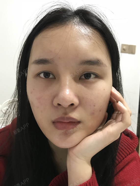 emmm.丑丑的我,在家休息就不想化妆啦,也算_圈子-新氧美容整形