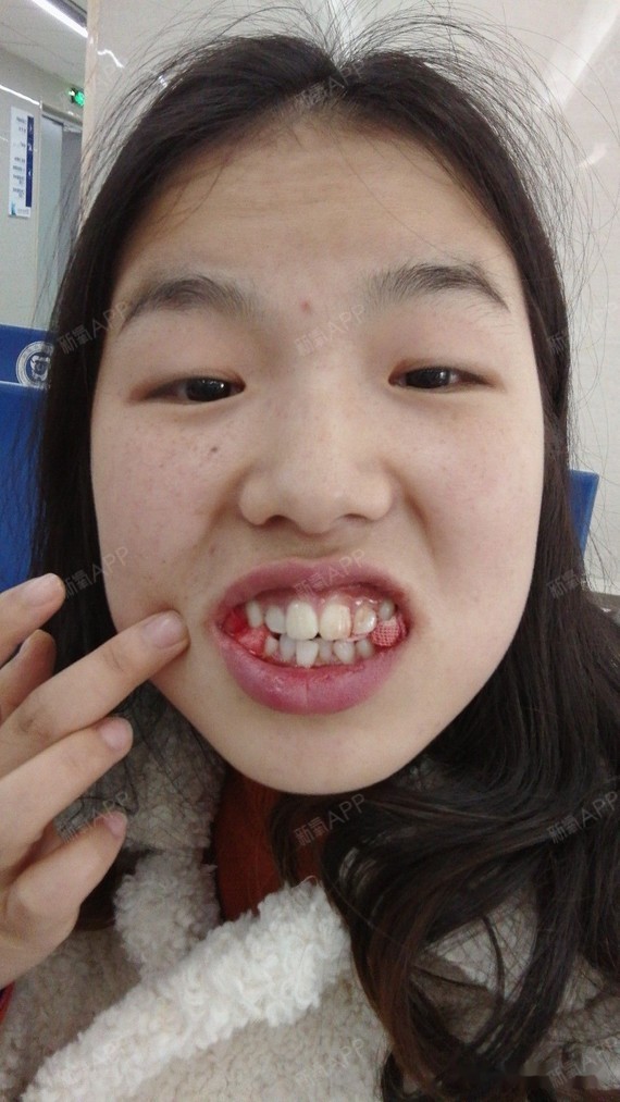 自己嘴凸想正畸带牙套矫正一下,并且从小就被我妈妈说"我牙齿这么齐