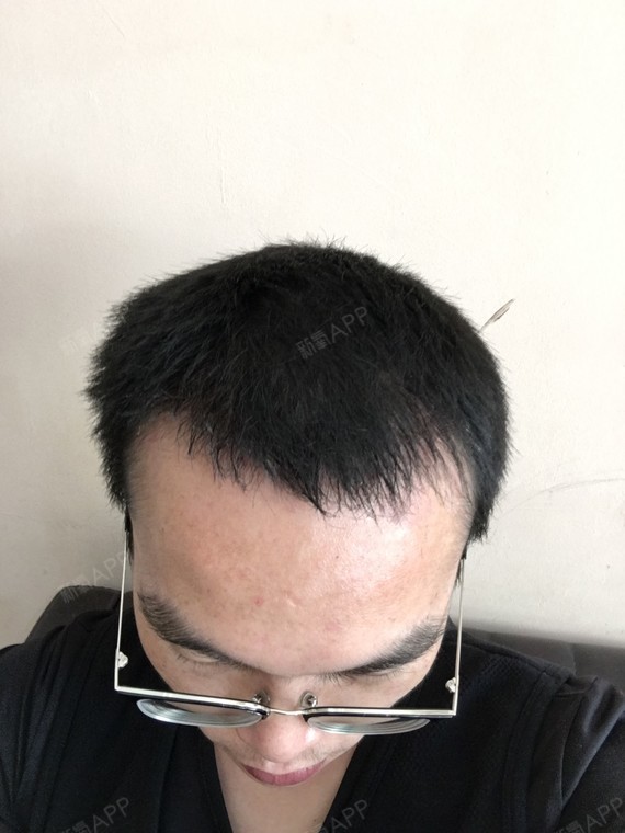 发际线种植后第二个月,效果正常,现在头发密度很高了