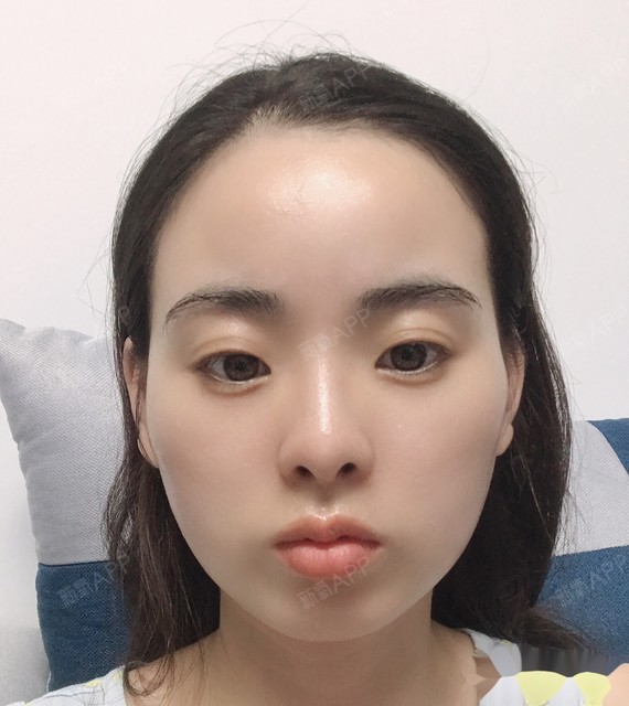 变了呀,牙套脸现在,颧骨凸出,太阳穴凹,脸颊凹