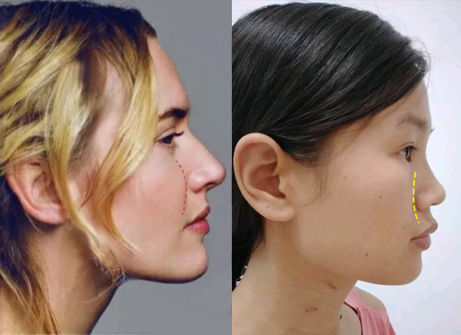 本来就上颌骨发育不足,然后随着年龄增加,骨质还不断地被吸收,再加上