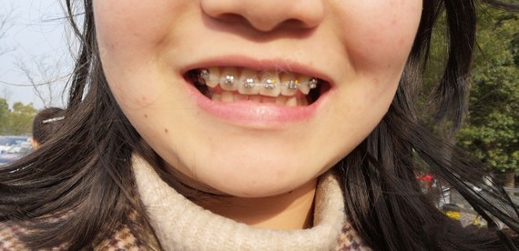 10开始矫正今天是成为钢牙妹的第100天,本人就是个小虎牙,不是非常