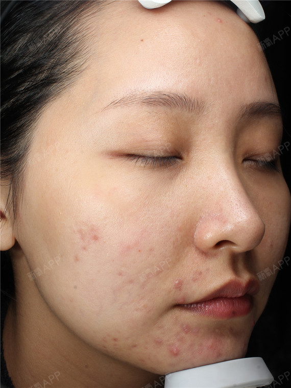 我来到了尚美,也是第一次接触这种医美机_圈子-新氧美容整形