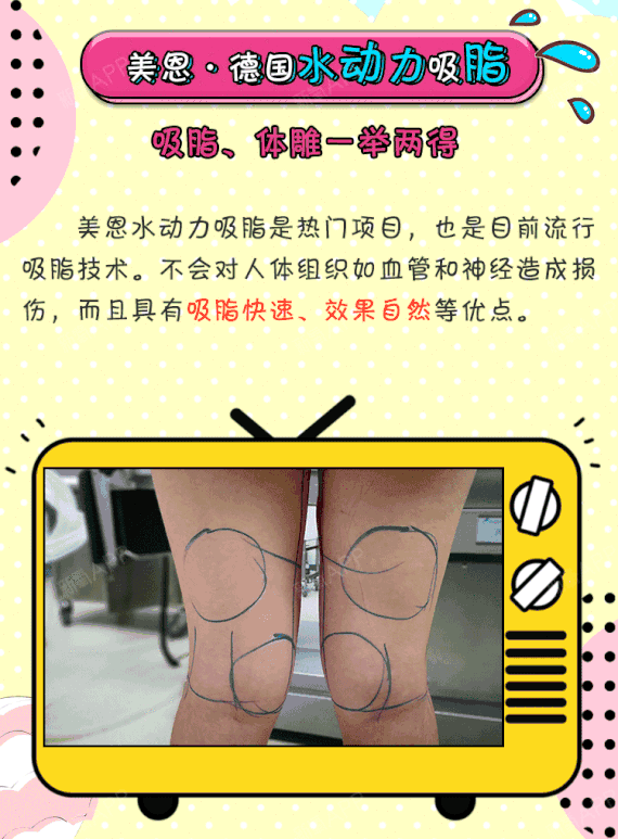 【吸脂】 24年省级医院 腰腹环吸 德国水动力吸脂 环吸 分层精雕