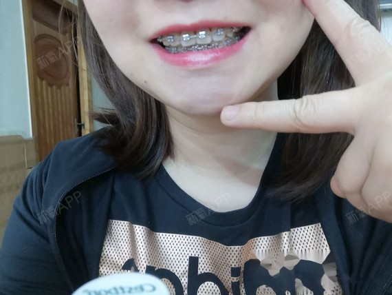 10开始矫正今天是成为钢牙妹的第100天,本人就是个小虎牙,不是非常