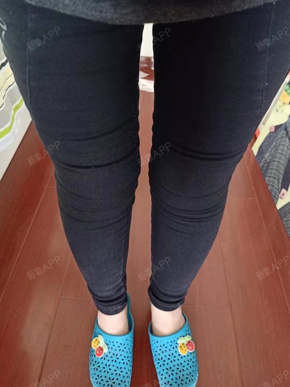 【大腿吸脂术后三个月了】大腿吸脂瘦腿打卡~在丽格做_圈子-新氧美容