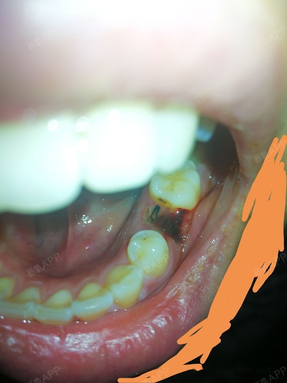 原来拔牙之后伤口会长假膜~惊了 想知道医生要如何拆线emmmm