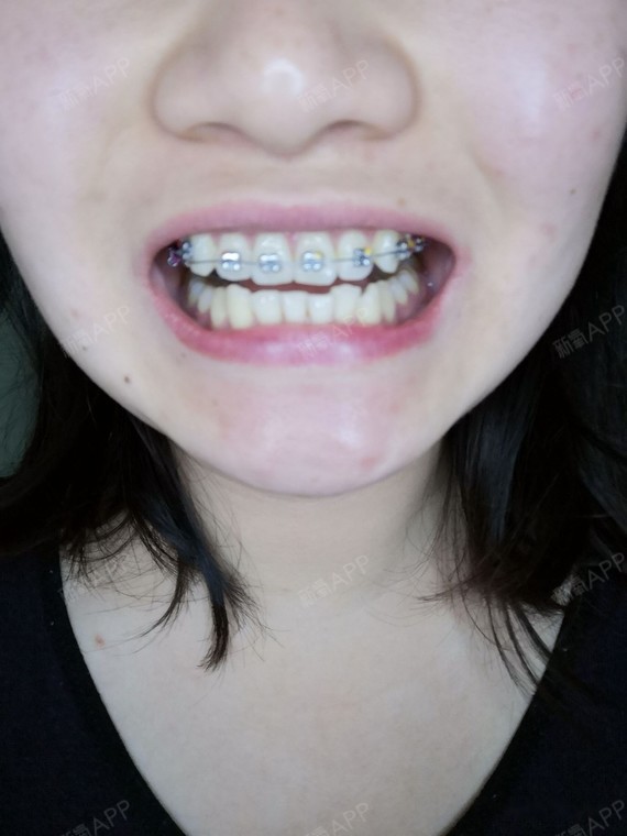 10开始矫正今天是成为钢牙妹的第100天,本人就是个小虎牙,不是非常