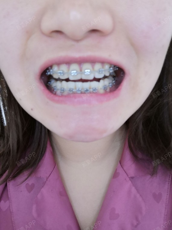 10开始矫正今天是成为钢牙妹的第100天,本人就是个小虎牙,不是非常