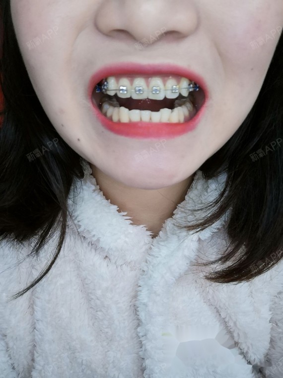 10开始矫正今天是成为钢牙妹的第100天,本人就是个小虎牙,不是非常