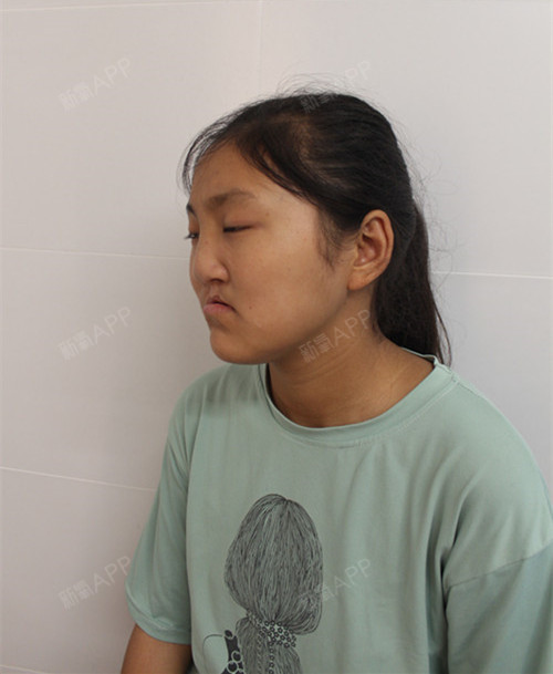 如果不是因为鼻子的情况已经严重影响到我的生活,或许_圈子-新氧美容