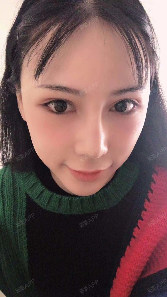 眼睑下至一晃快两个月了,嘻嘻,是不是美美哒,翻看以_圈子-新氧美容