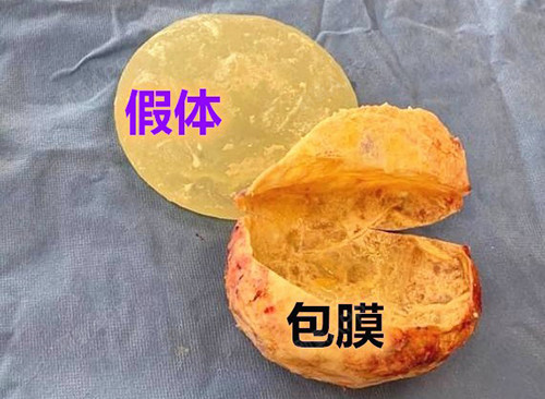 假体种类及置入层次是影响假体隆胸术后包膜挛缩形成的重要因素