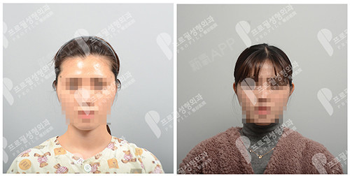 首页 此页面仅支持预览 Avatar Beauty变形记 162篇日记 贴面 脑 耳朵可以做手术矫正吗 哪里可以做 耳朵太贴脑袋 也就是我们常说的贴脑 耳 贴发耳 其表现在耳朵与颅骨之间夹角过小 从正面看耳朵过小或者根本看不到耳朵 虽说耳朵这个部位小 但是