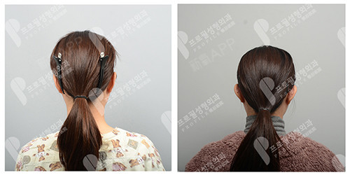 贴面 脑 耳朵可以做手术矫正吗 哪里可以做 耳朵太 圈子 新氧美容整形