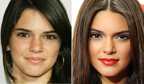 深扒肯豆整容史!