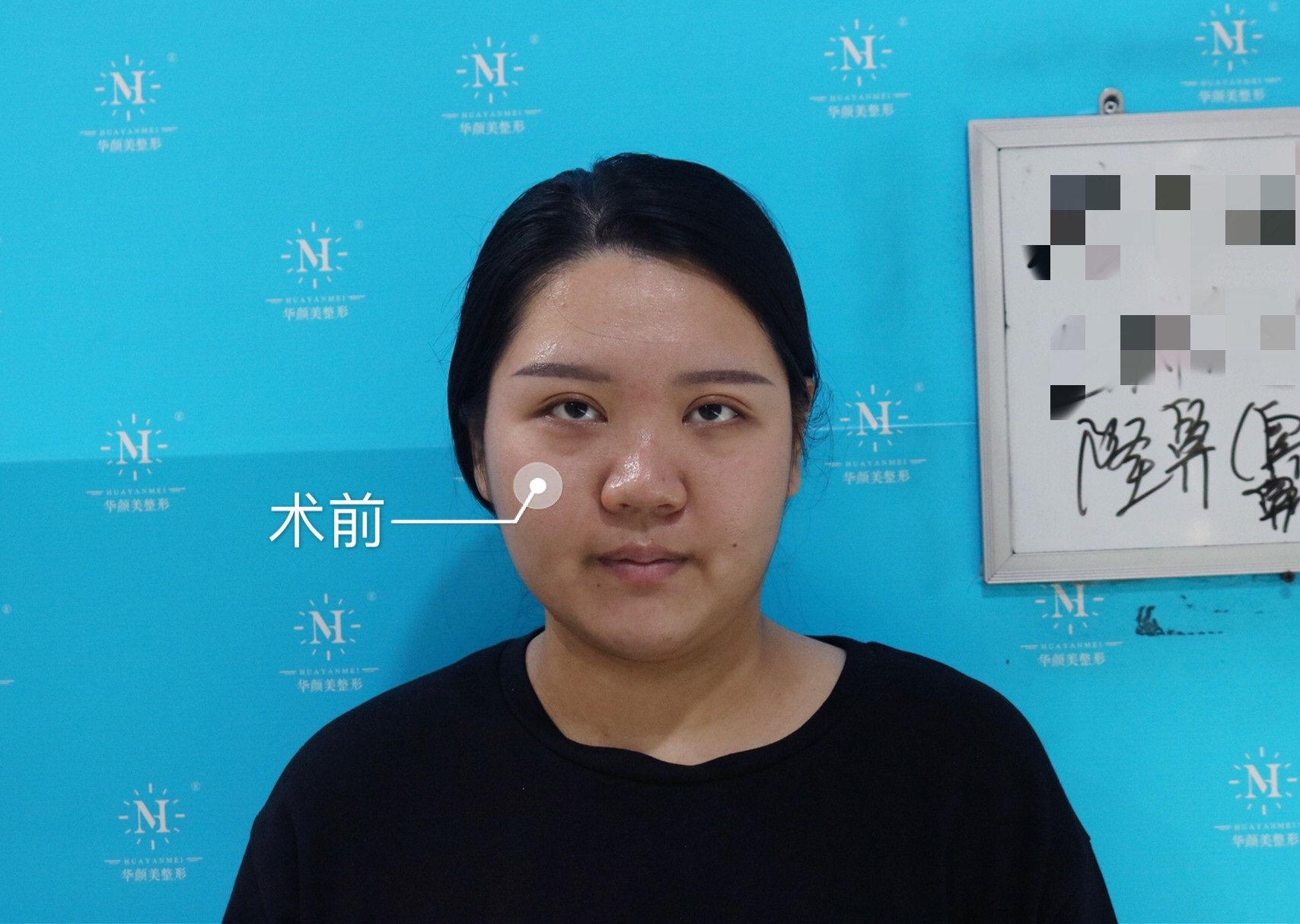 永久隆鼻可以做几次_隆鼻可以永久吗_永久隆鼻可以喝酒吗