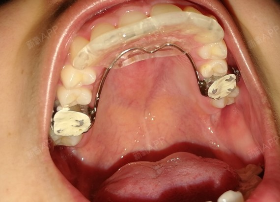 2019/9/10更新戴了四个月零三天的固定平导终_圈子-新氧美容整形