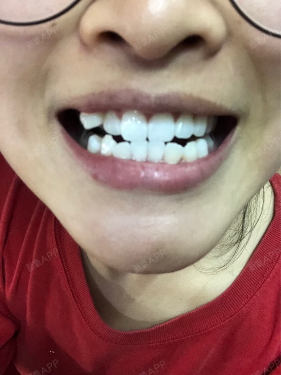 说一下情况吧,自己牙齿右边三号牙一开始就有虎牙,而_圈子-新氧美容