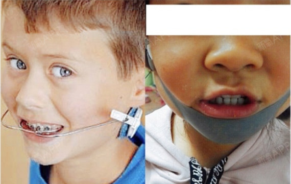 正颌正畸联合治疗 大家好~~我是专门为大家解决牙齿_圈子-新氧美容