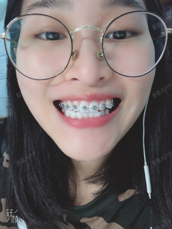 说一下情况吧,自己牙齿右边三号牙一开始就有虎牙,而_圈子-新氧美容