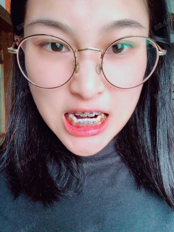 说一下情况吧,自己牙齿右边三号牙一开始就有虎牙,而_圈子-新氧美容