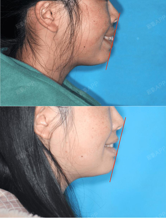 迷人颏部变出来你能想象,这个娇俏_圈子-新氧美容整形