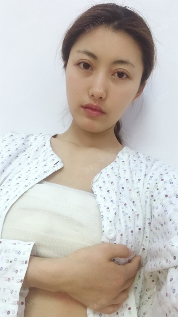 【南京美贝尔整形医院-假体隆胸】胸部一直裹着纱布,_圈子-新氧美容