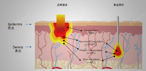 祛疤最前线---点阵激光你了解多少?