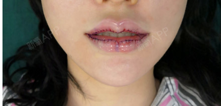 做这个m唇了,有想过打个玻尿酸的,好看的整形嘴唇图片做嘴巴整形图片