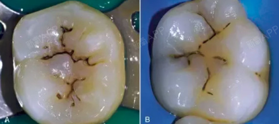 最近有粉丝私信给科普君,"早上明明好好刷牙了,为什么牙窝上还是会有