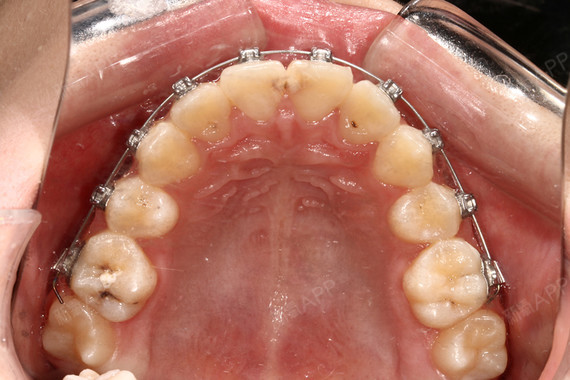 钢丝矫正牙齿一年多后,此前参差不齐的小乱牙慢慢归位_圈子-新氧美容