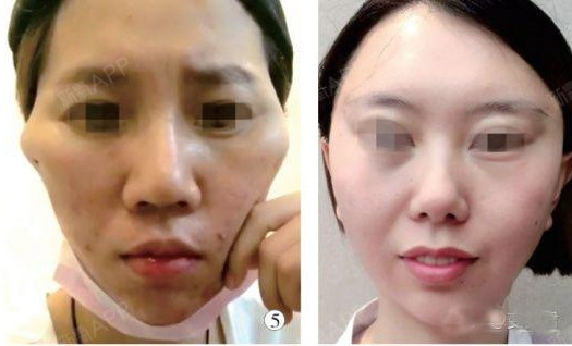 做过面部线雕的来说说埋线提升面部后遗症有哪些?