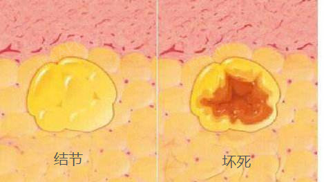 受到損傷形成結節(此損傷不影響健康,結節也為良性)或者是血腫機化