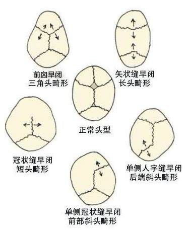 三角头畸形 冠状缝图片