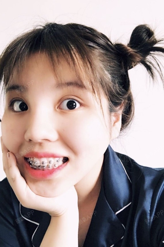 这是我戴牙套后的自拍及手机相册