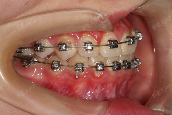 戴上钢丝矫正器后,虽然在此期间,比如刚开始时会有牙_圈子-新氧美容