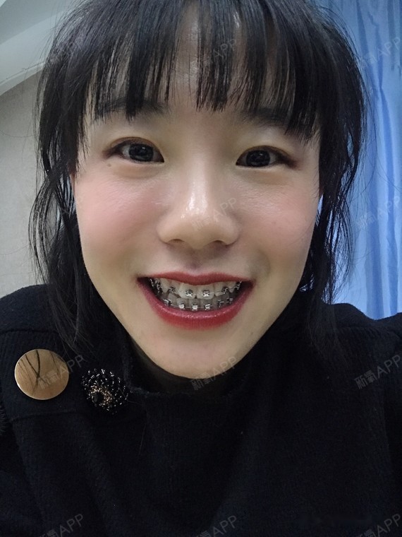 来,观摩了将近两年戴牙套的各种经历,现在我终于有