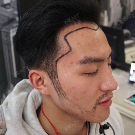 帅气哥哥来也~发际线77鬓角种植,你和男神只差一个发_圈子-新氧美容